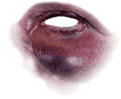 眼圈擦伤,black eye bruise PNG