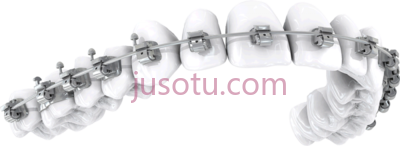 矫正牙套,why braces orthodontic brackets PNG